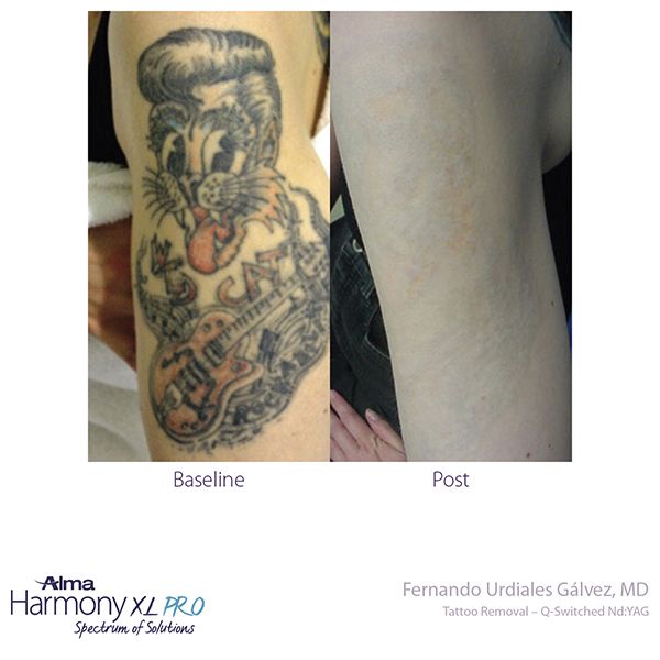Big ass black tattoo that'd been reworked twice before biting the removal  bullet. 2 years and 10 or so sessions later, she gone. : r/TattooRemoval